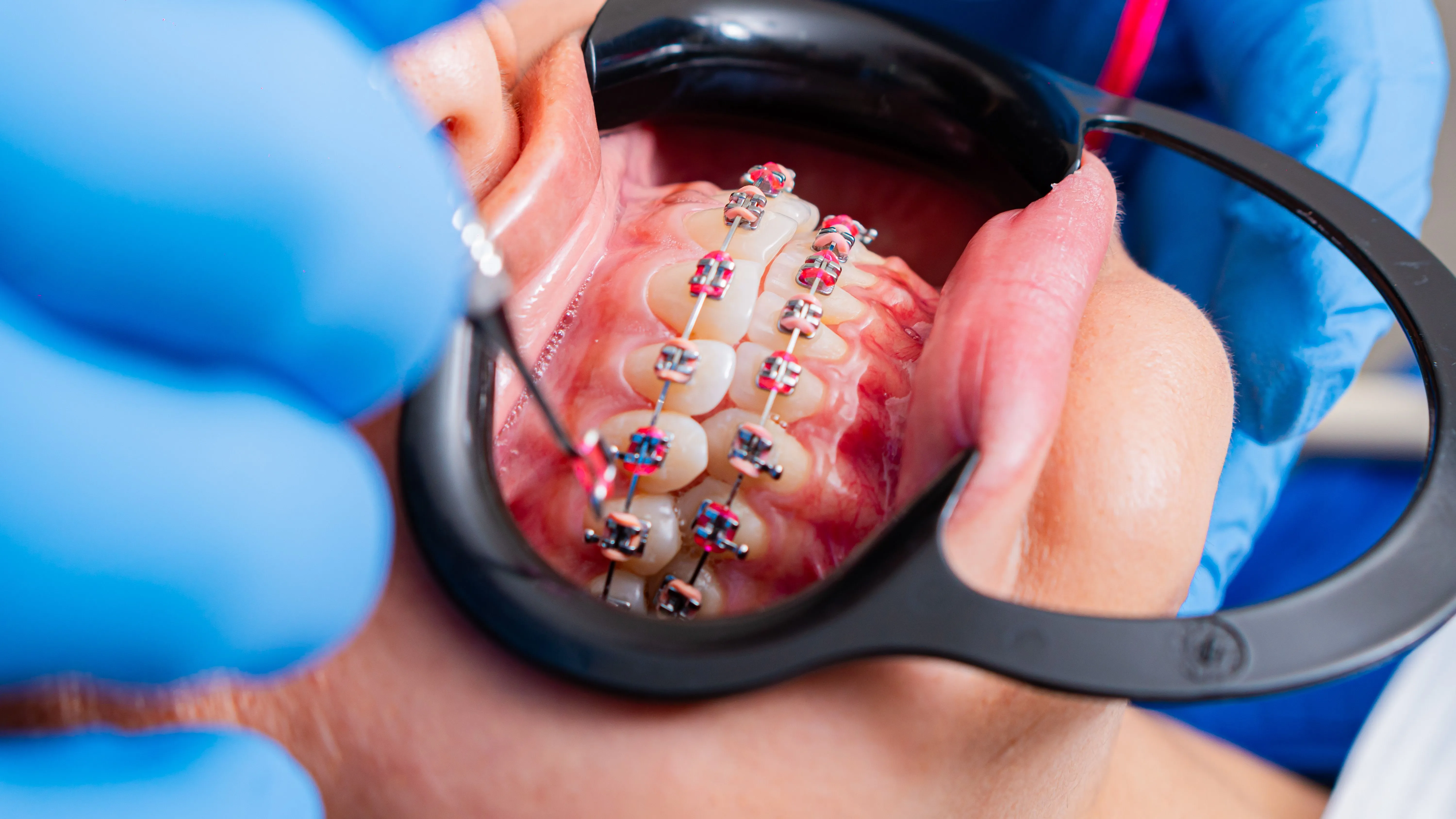 Best age for braces guide for children and teens by Brite Smile Dental Care Lucknow